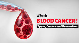 What is Blood Cancer? Types, Causes and Prevention