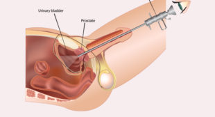 What is Optical Internal Urethrotomy? How does it help?