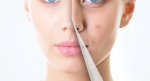 How To Get Acne Free Skin? – Derma Klinic