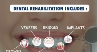 Excellent teeth replacement Dental Hospital in Chennai Excellent teeth replacement Dental Hospital in Chennai