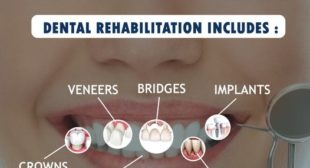 Excellent teeth replacement Dental Hospital in Chennai