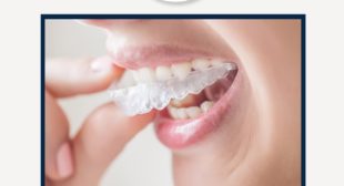 Best dentist in TNagar – Impact dental center